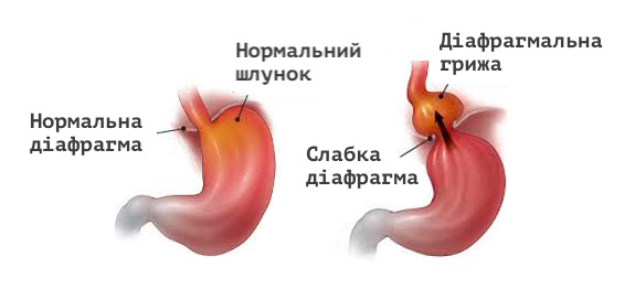 Грижа стравохідного отвору діафрагми